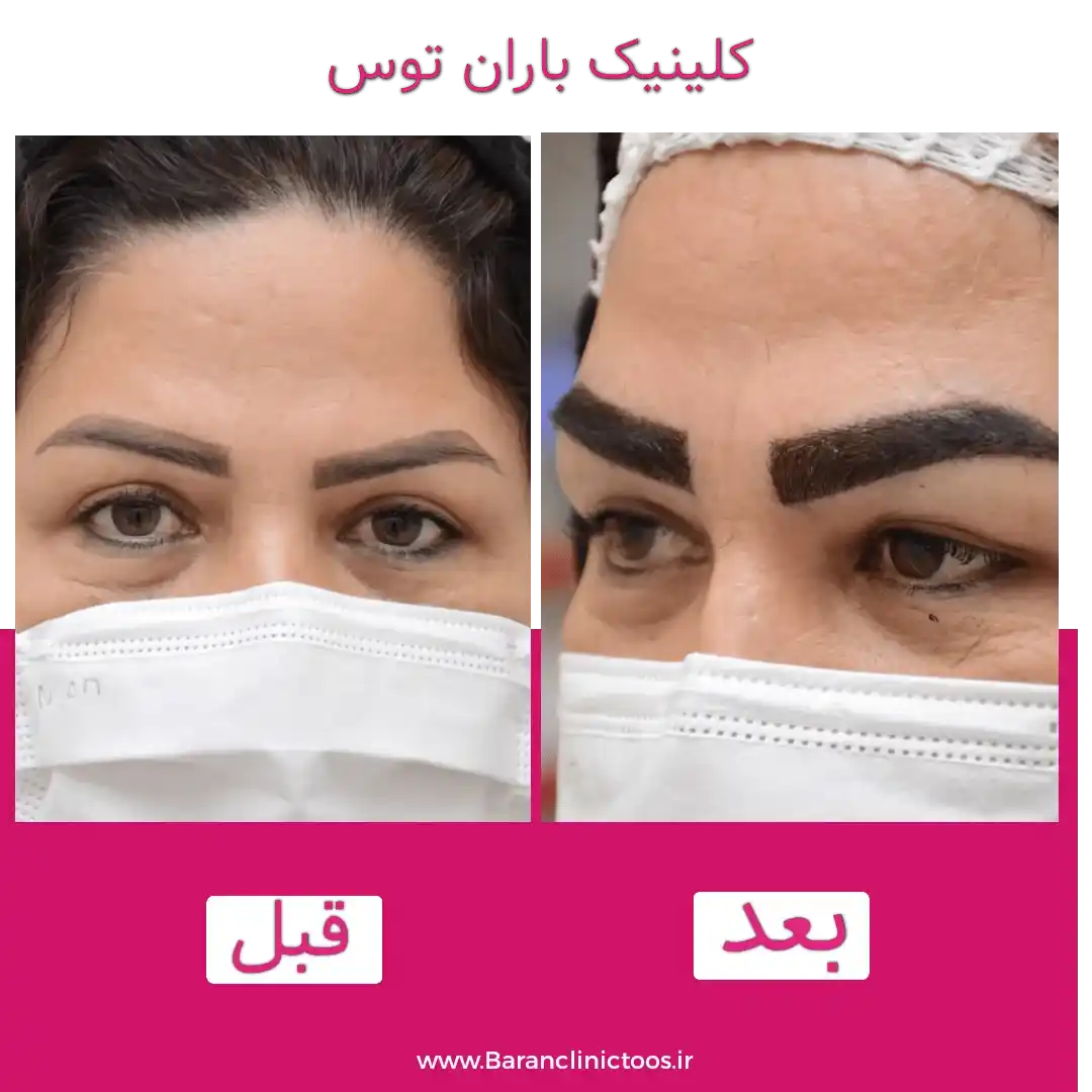 قبل و بعد کاشت ابرو